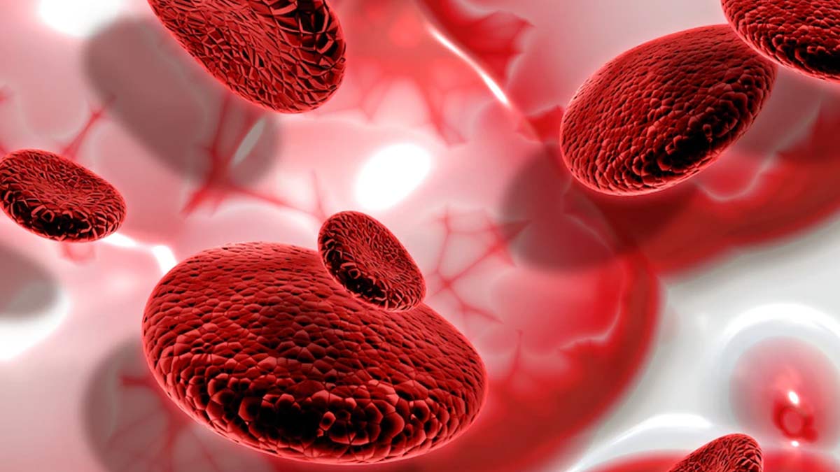 anemia
