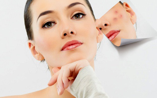 Acne-And-Pimple-Marks