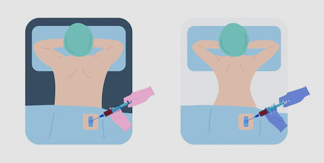 Total Body Irradiation
