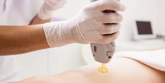 Laser- Hair-Removal-in-Hindi