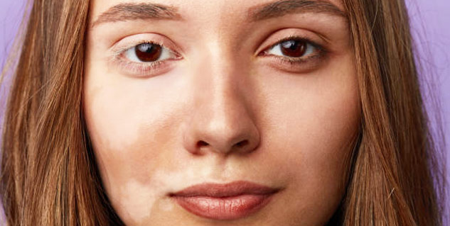 white patches in hindi