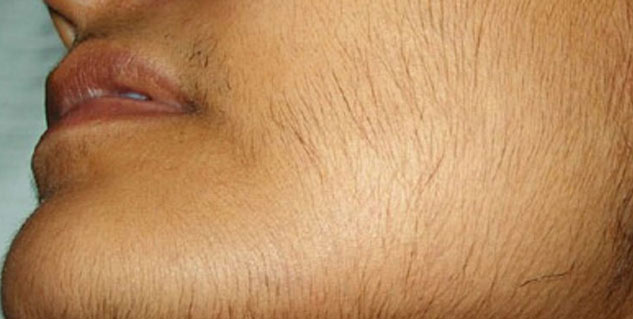 Excessive-hair-causes