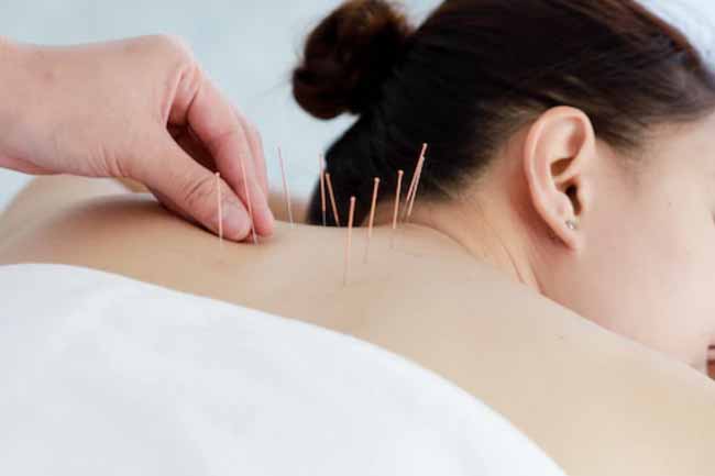 Acupuncture