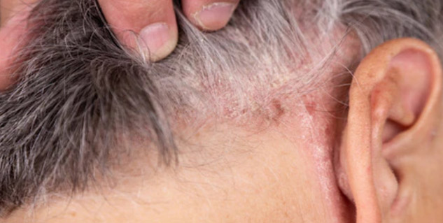Scalp-Psoriasis-in-Hindi