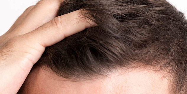 Scalp-Psoriasis-in-Hindi