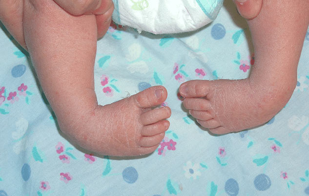 clubfoot leg