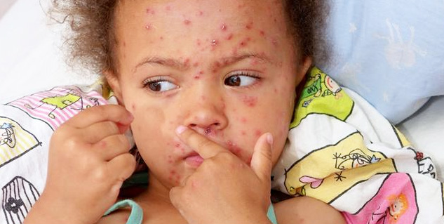 chickenpox
