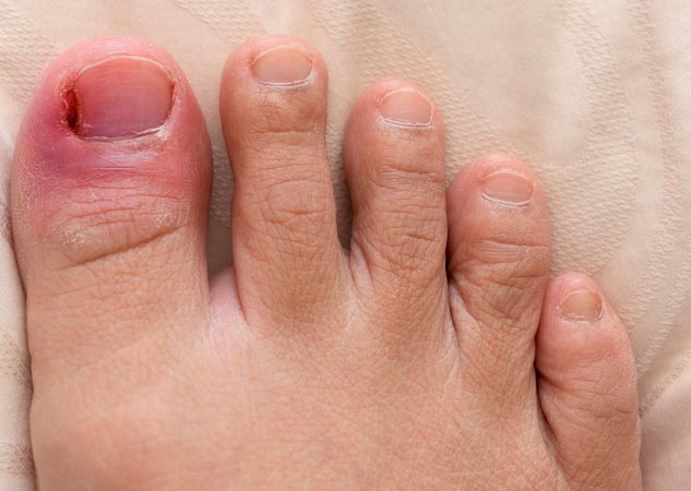 kids-ingrown-toenail