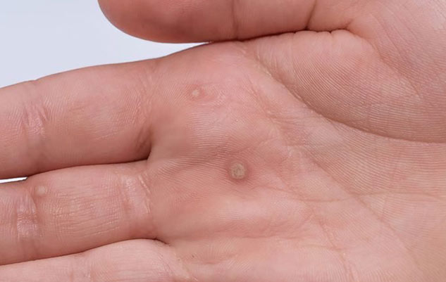 Dyshidrosis-in-Hindi