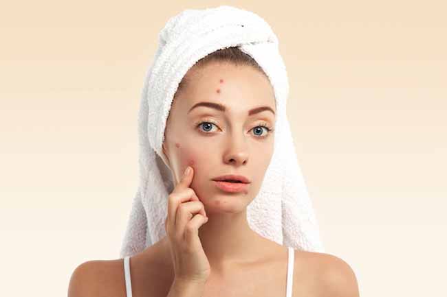 Home remedies to treat pimple overnight