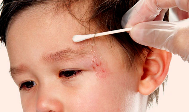Kids-Injury-Treatment-Tips