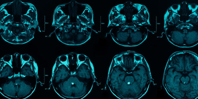 Hemorrhage-of-brain-details-onlymyhealth