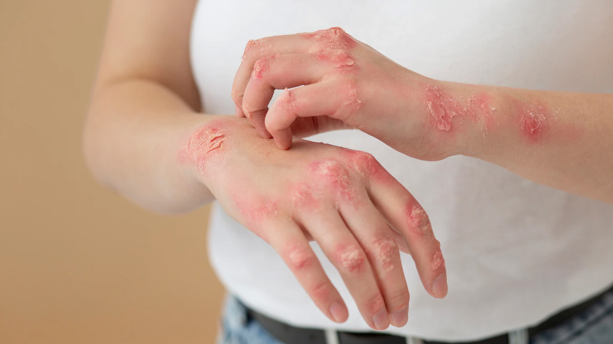 High-Cholesterol-Skin