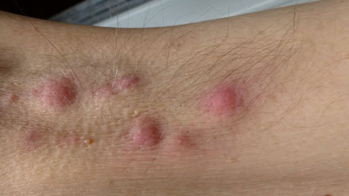 pimples due to sweat