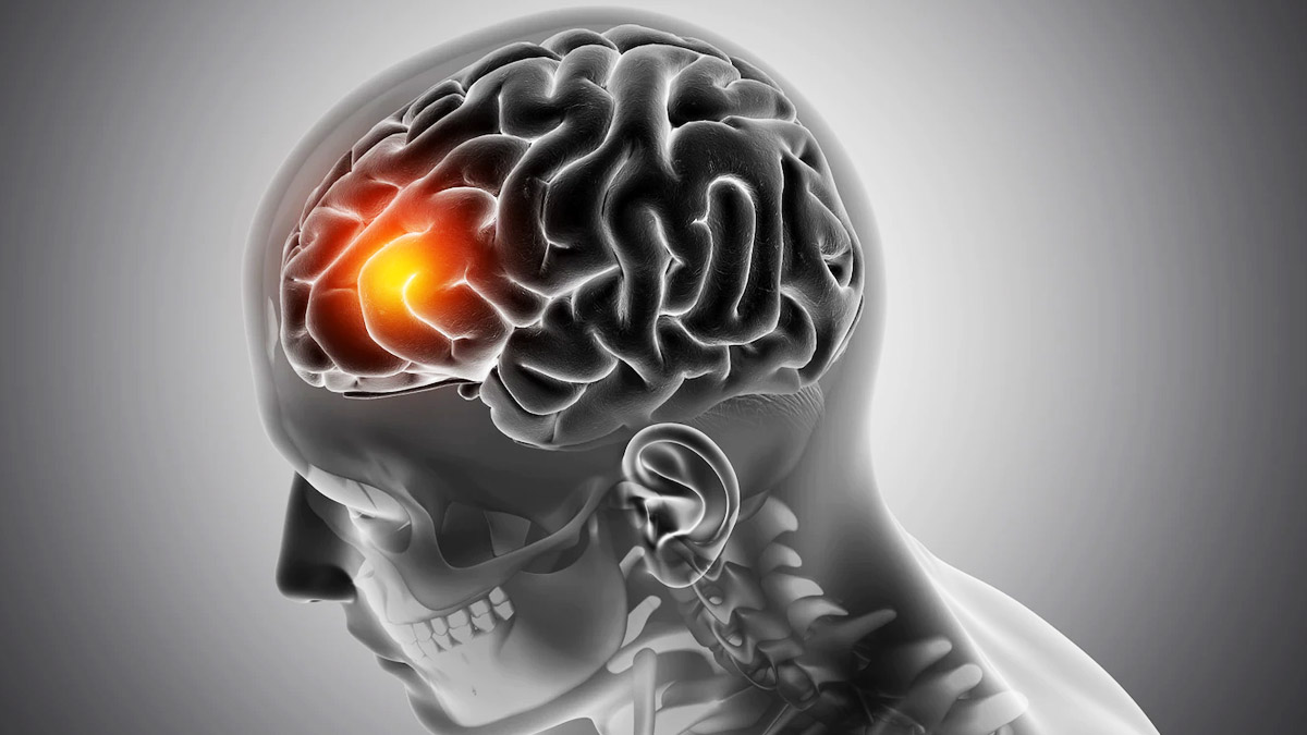 does 5g lead to cancer