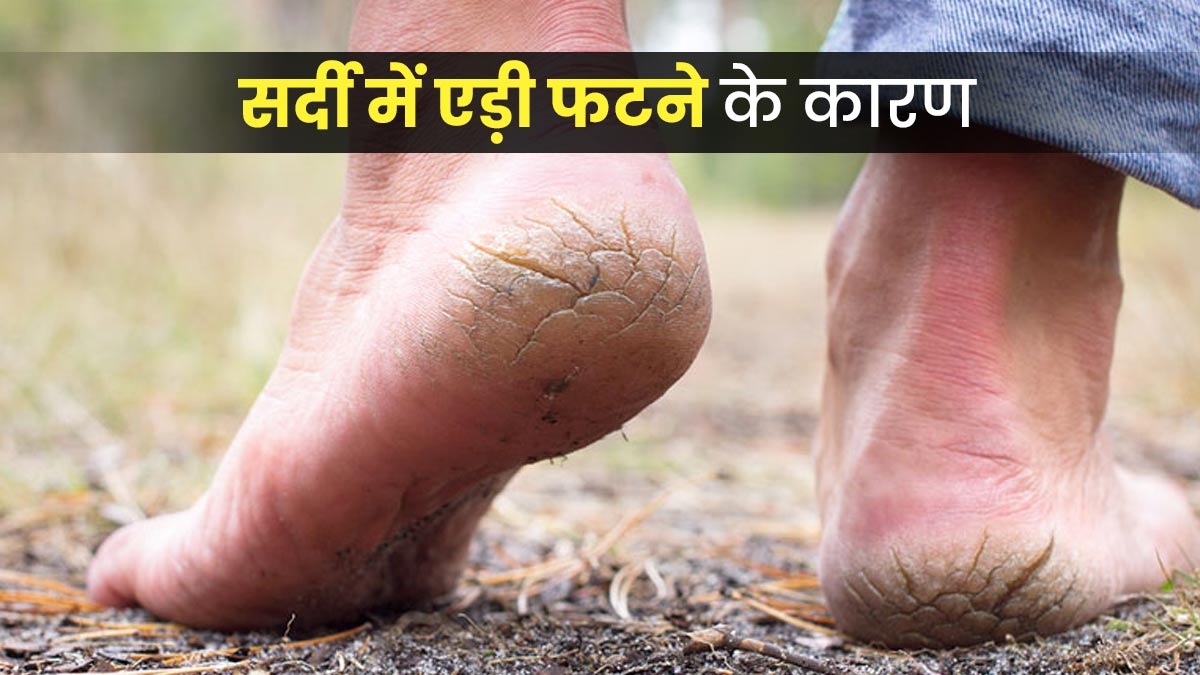 सर्दियों में एड़ी फटने के हो सकते हैं ये 6 कारण