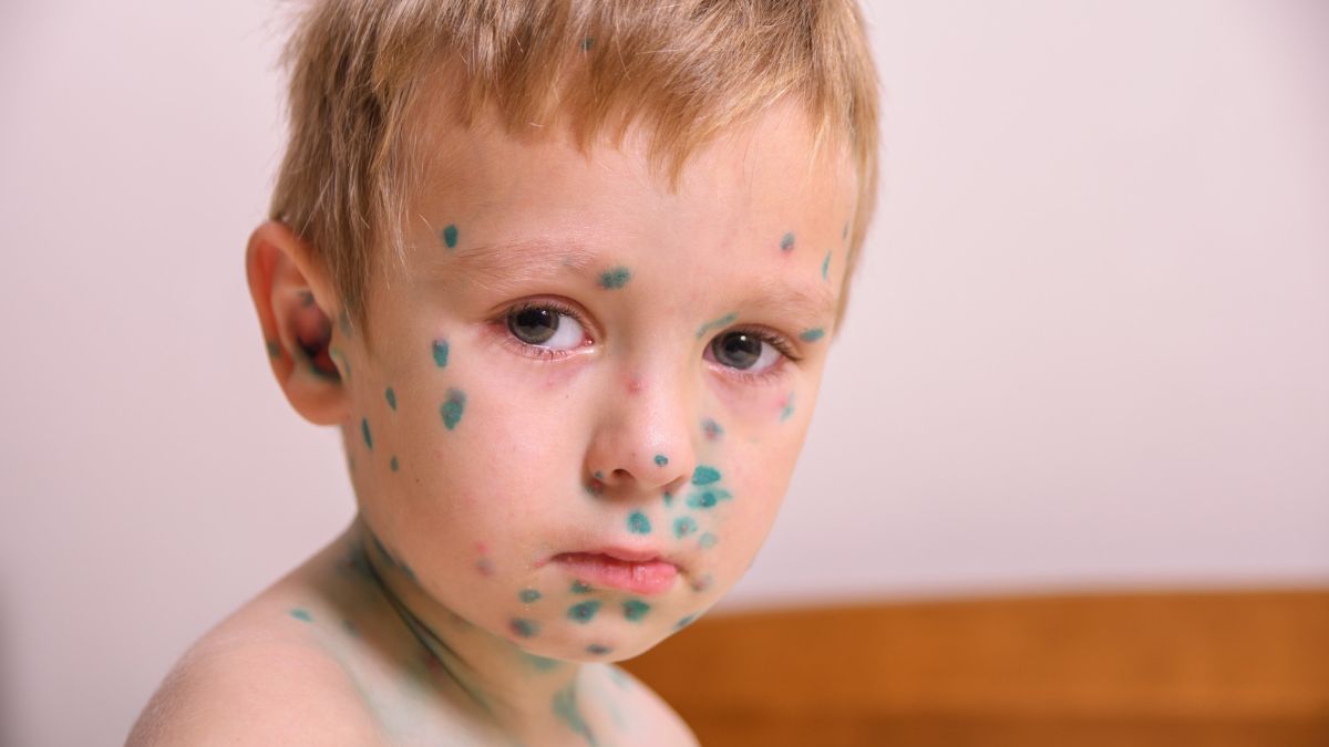 Measles Outbreak in India