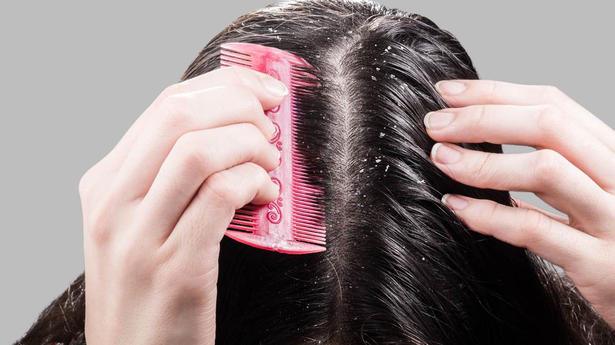 mustard oil and coconut oil for dandruff