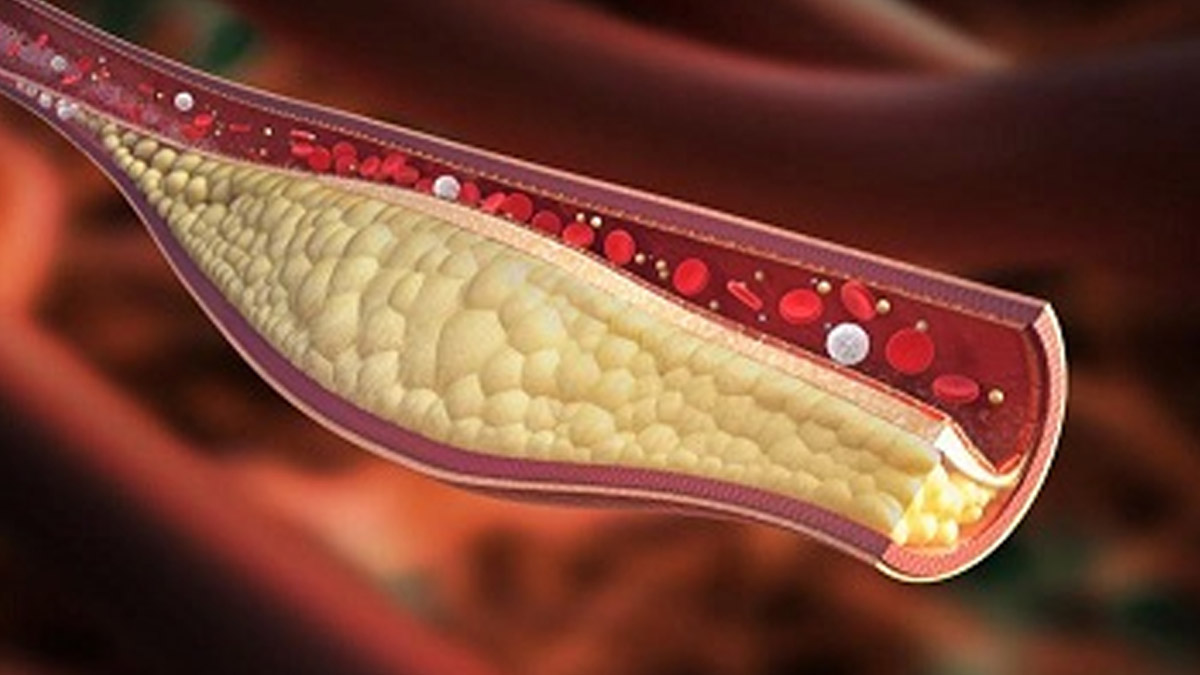 cholesterol cause weak heart