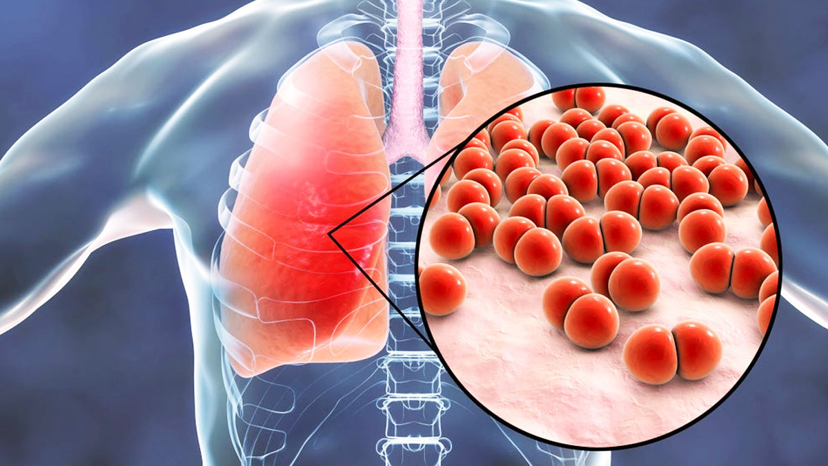 bulla disease causes