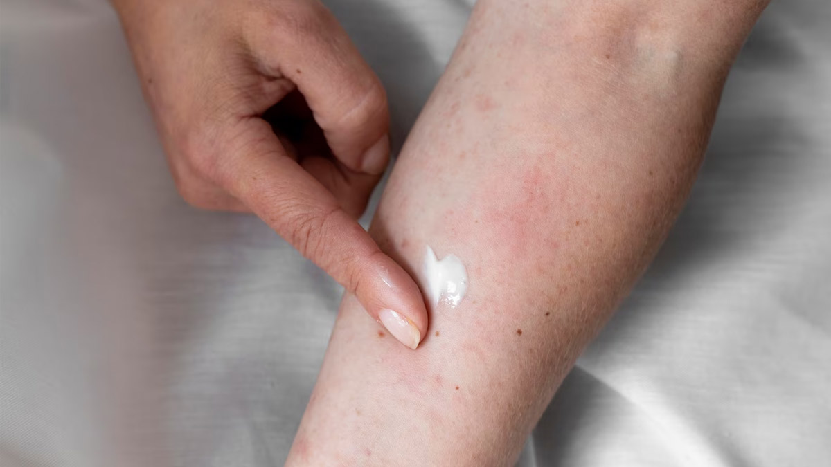 what not to eat in eczema