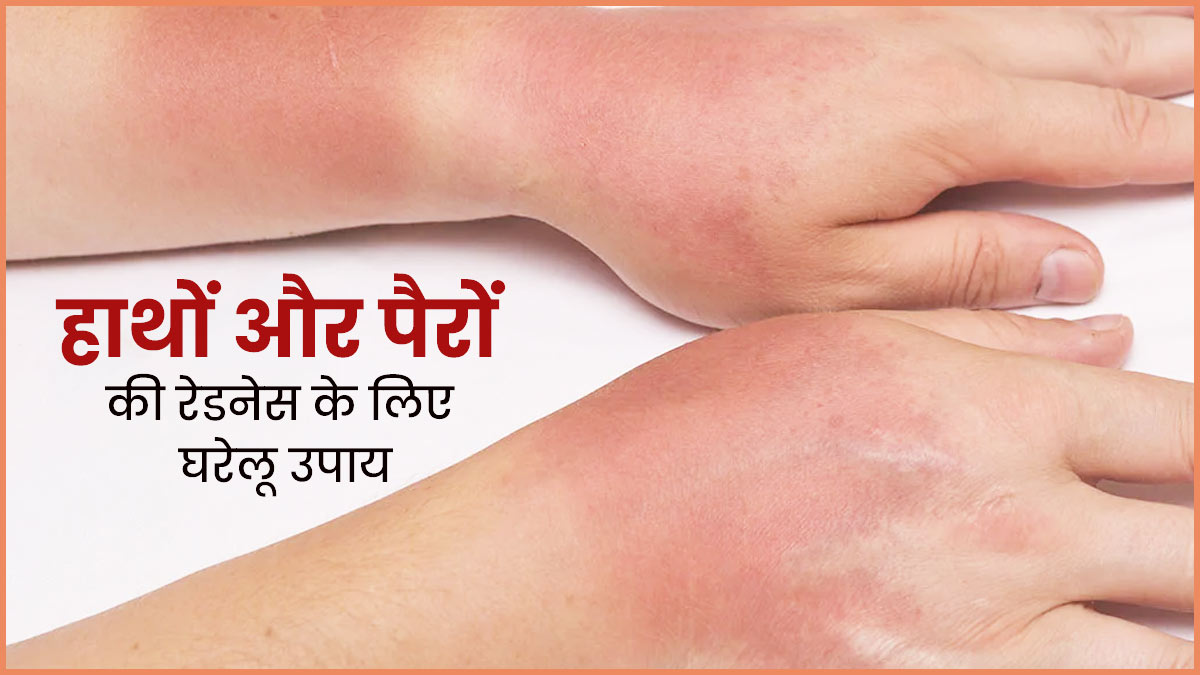 गर्मियों में हाथ-पैर हो जाते हैं लाल? जानें इसे कम करने के 5 उपाय