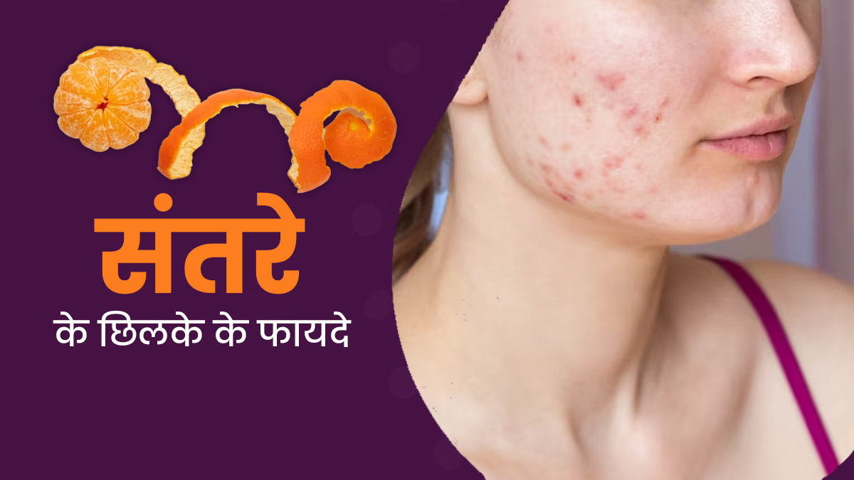 कील-मुंहासे हो जाएंगे छूमंतर, चेहरे पर इस तरीके से लगाएं संतरे के छिलके