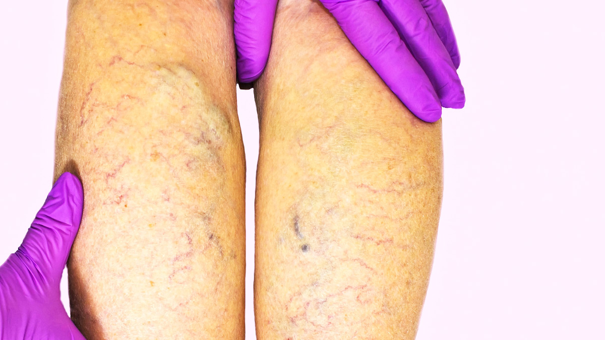 peripheral artery diseas