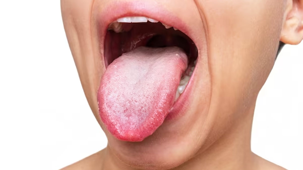 Vitamin-D-Deficienc-Symptoms-On-Tongue