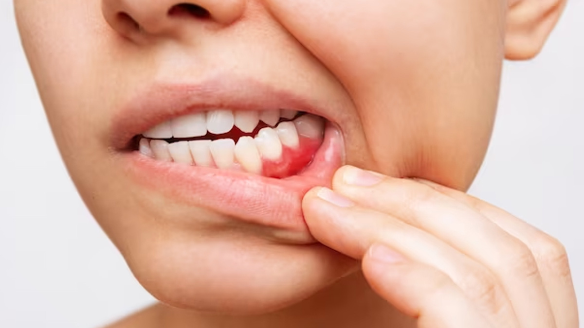 Cracked Tooth Syndrome in Hindi