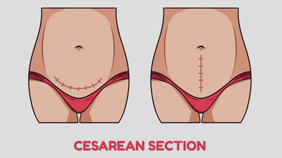 Risk Of A Caesarean Delivery In Expecting Mothers: Expert Weighs In The Tips To Reduce It 