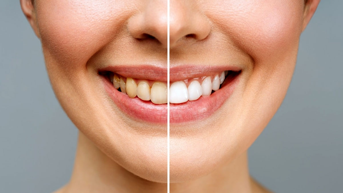 Embarrassed By Yellow Teeth? Natural Remedies To Whiten Them