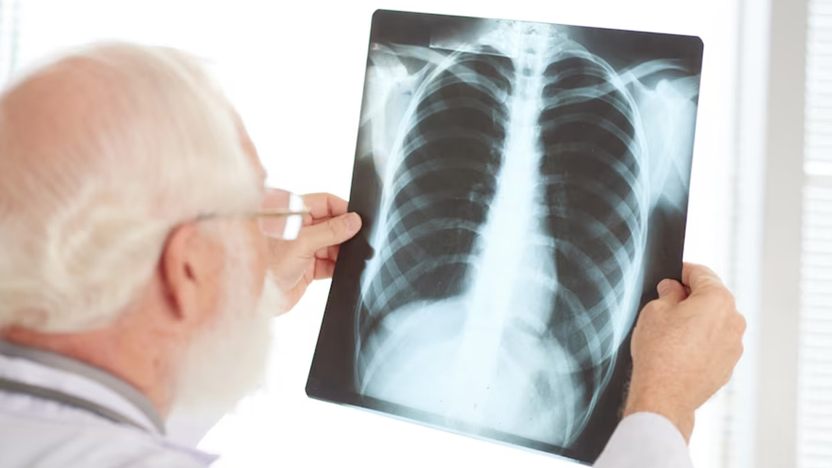 What is Silicosis in Hindi