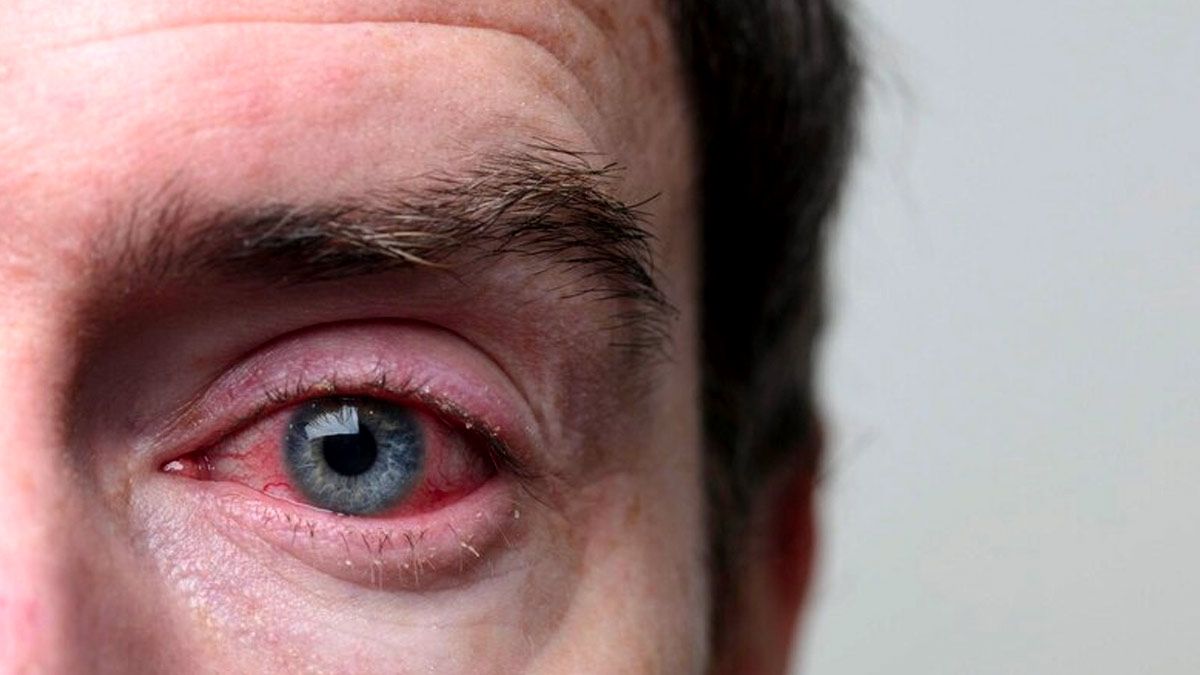 Can Wearing Dark Glasses Prevent Eye Flu