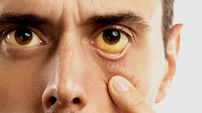 Do You Notice Yellow Discolouration Of Body? Expert Explains Jaundice In Details
