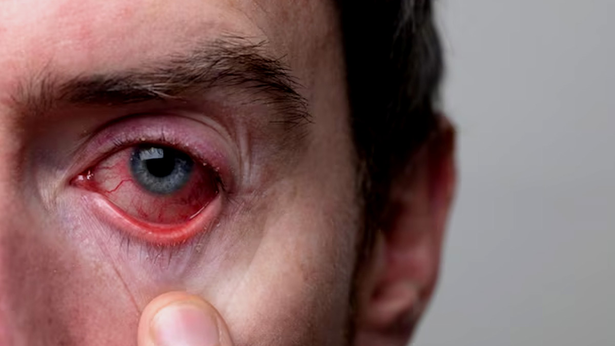 eye infection in hindi