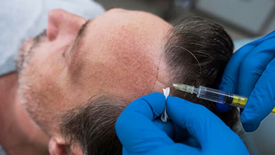 Hair Transplant: Things To Consider And What Precautions To Take Post Surgery 