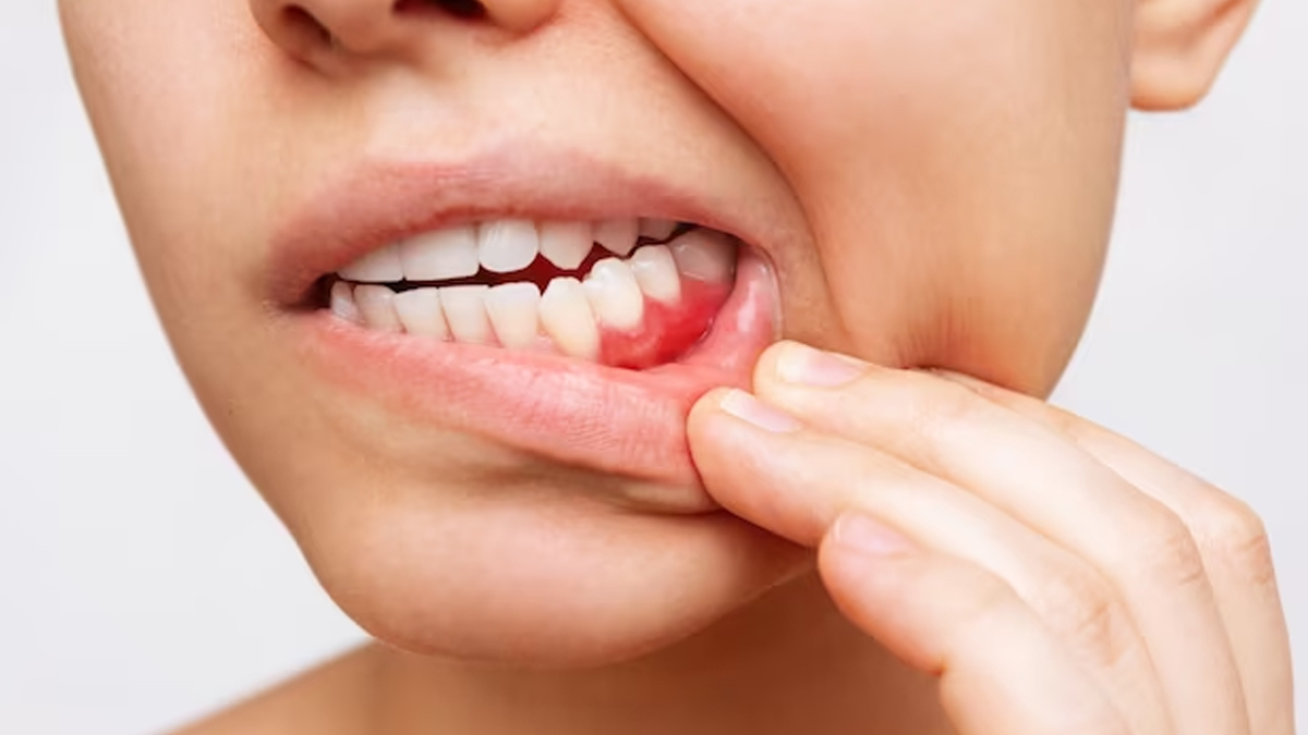 Bleeding-Gums-How-To-Spot-Gum-Disease-Early