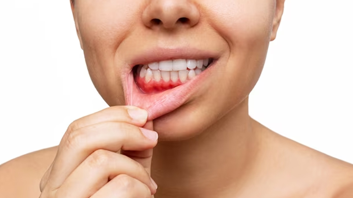 How-To-Spot-Gum-Disease-Early