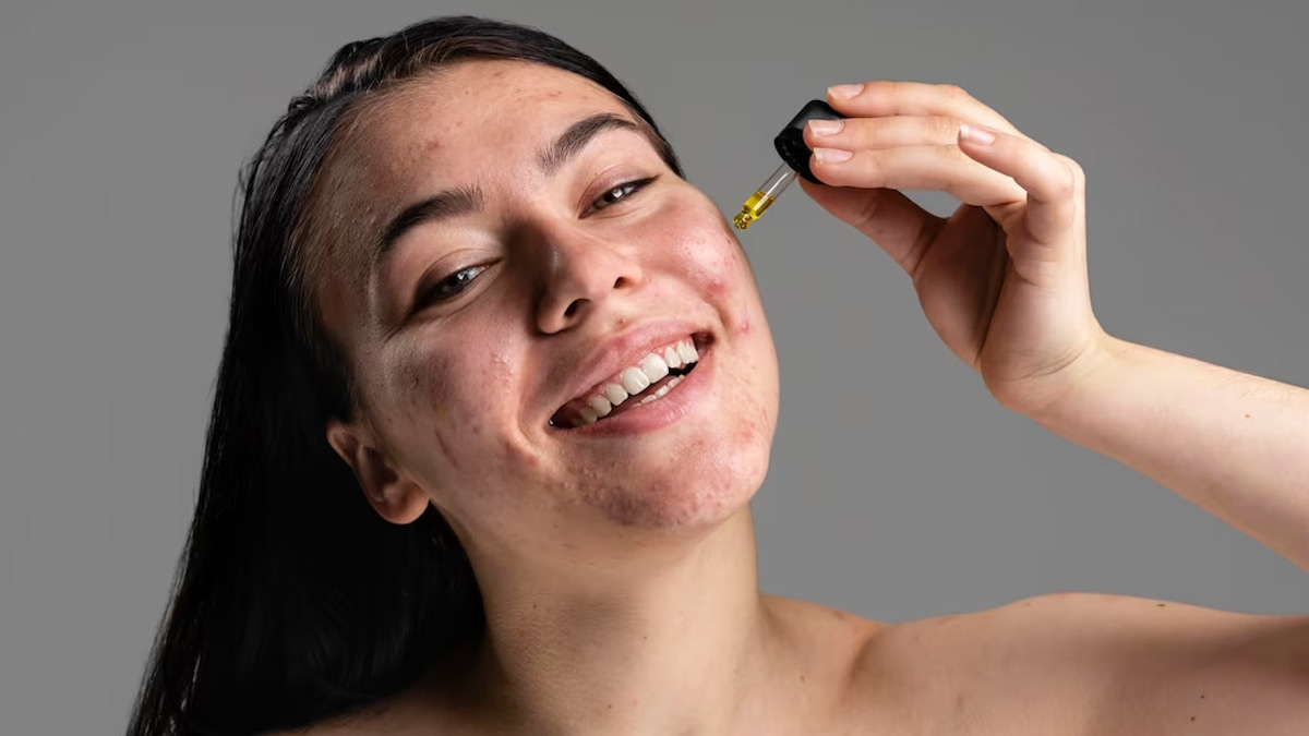 Fighting Acne: Benefits Of DIY Serums And How To Make It 