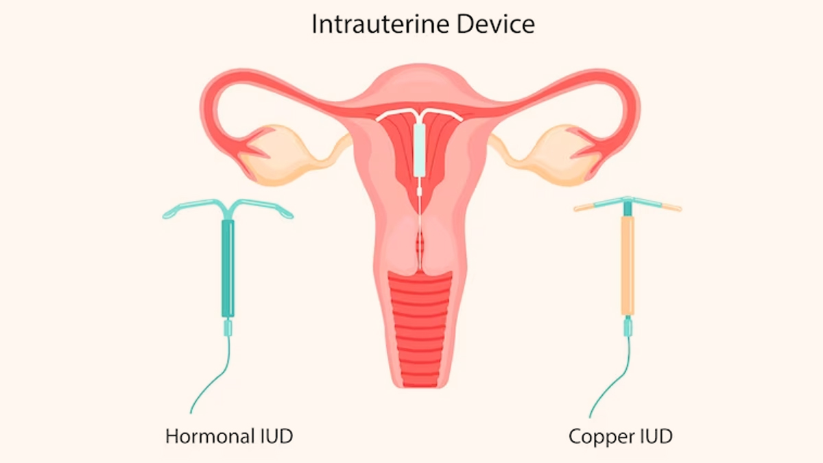 contraceptives for breastfeeding mothers