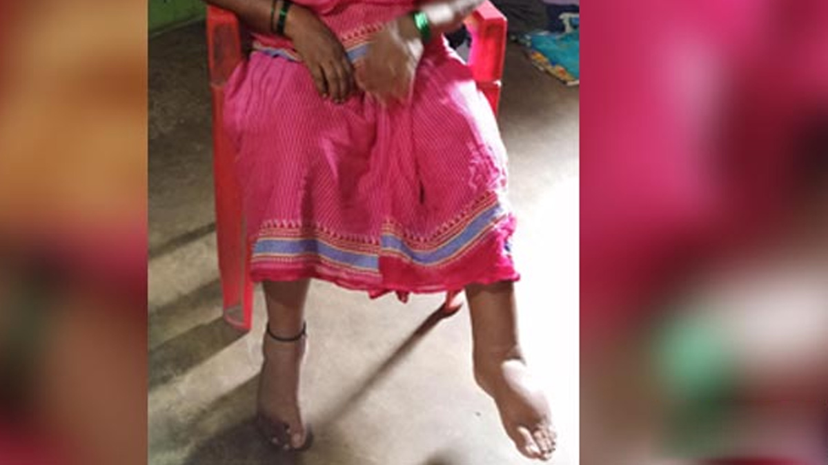 lymphatic filariasis In hindi