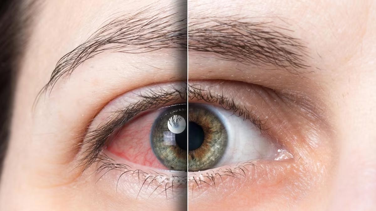 Conjunctivitis Explained: Can Eye Flu Spread Just By Looking Into Someone’s Eyes? 