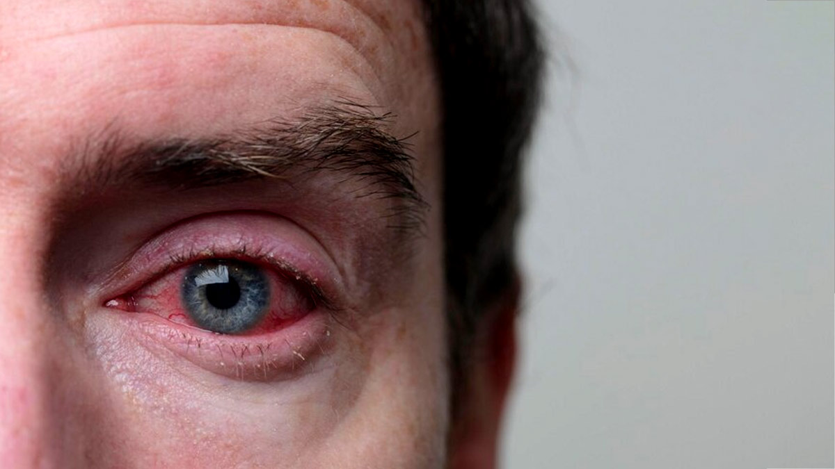 Conjunctivitis Care: Follow These Tips For Quick Recovery