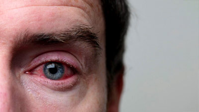 Conjunctivitis Care: Follow These Tips For Quick Recovery