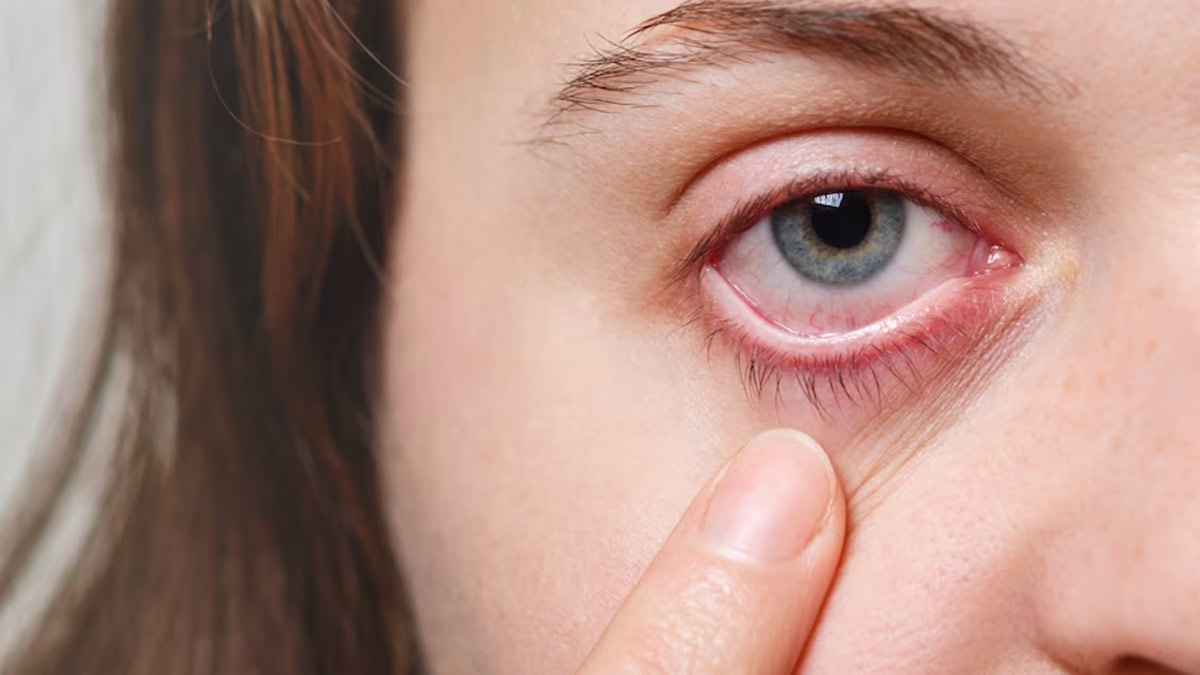 Conjunctivitis: All You Need To Know About The Causes, Symptoms, Prevention, And Treatment 
