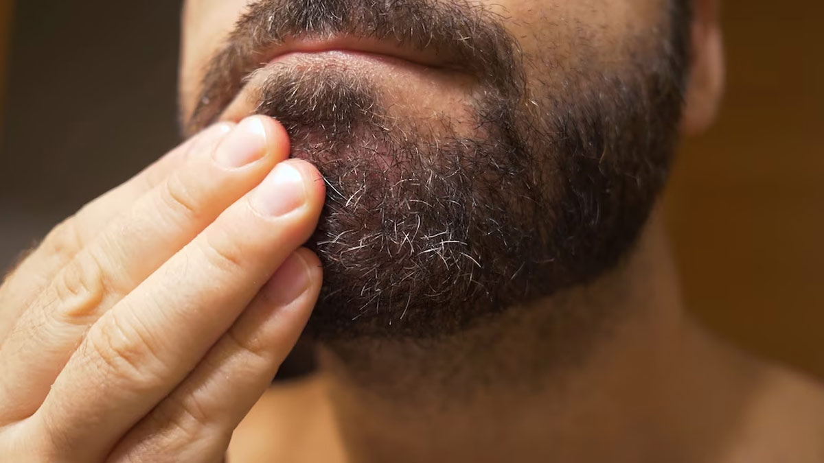 Beard Dandruff: Here's How You Can Get Rid Of It Naturally
