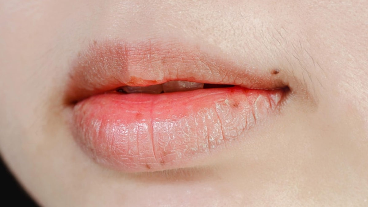lips cracking in hindi
