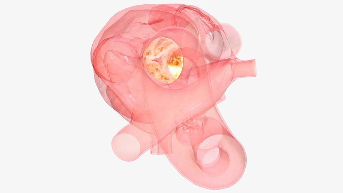 aortic-regurgitation