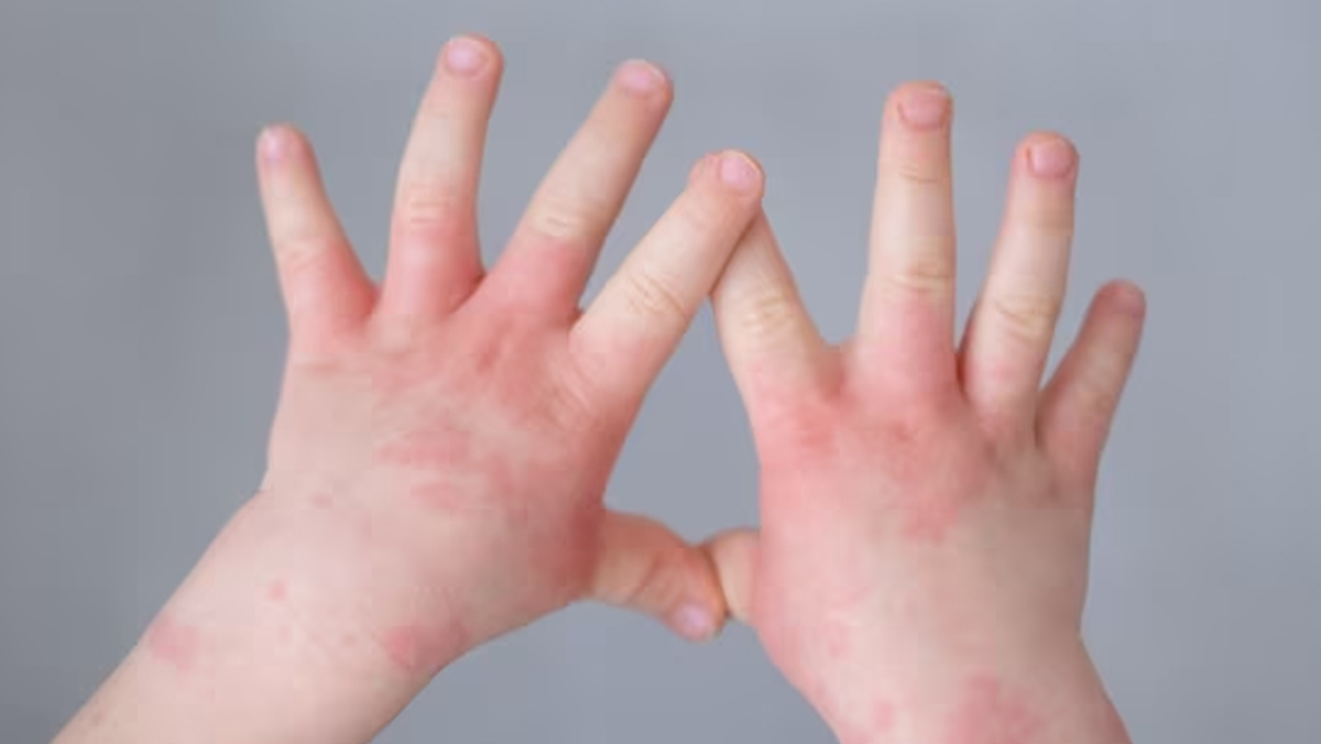 Nutrients To Improve Psoriasis In Hindi